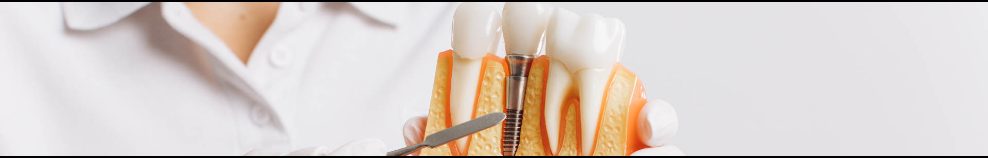 implants dentaires argenteuil